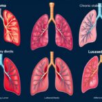 types of lung diseases